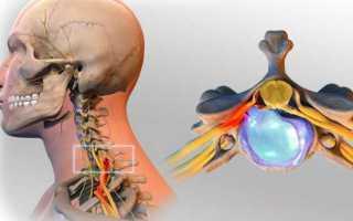 Грыжа и протрузия шейных позвонков: как лечить и советы по плаванию