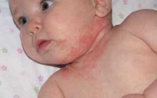 Возможные причины сыпи на шее у ребенка