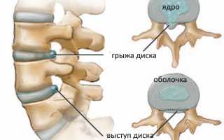 Протрузия дисков позвоночника поясничного отдела: как лечить современными методами