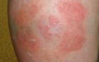 Аллергия на пластырь: подтверждаем симптомы и лечим проблему