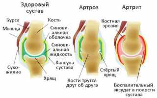 Артроз суставов – чем лечиться?