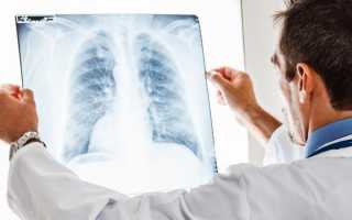 Как облегчить кашель при пневмонии