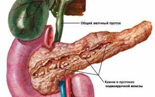 Панкреатит: как лечить болезни поджелудочной?