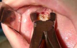 Что делать, если из-за зуба болит горло