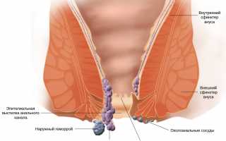 Вываливание узлов геморроя