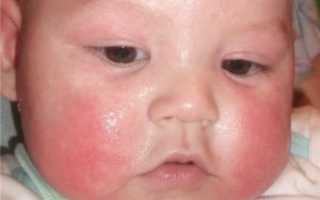 Аллергический дерматит у детей: внешняя симптоматика и методы лечения