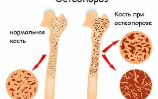 Лечение народными средствами остеопороза: эффективные и доступные методы