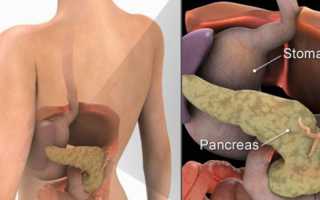 Лечение панкреатита