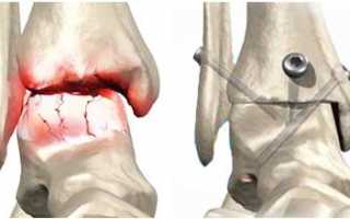 Артродез сустава как крайняя мера терапии