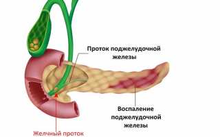 Панкреатит — что это такое, причины и симптомы воспаления поджелудочной железы