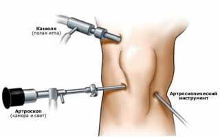 Реабилитация после артроскопии коленного сустава