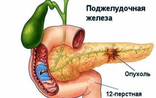 Почему увеличивается поджелудочная железа