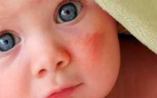 Причины, симптомы, диагностика и лечение аллергии на щеках у детей и взрослых