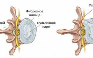 Грыжа шейного отдела позвоночника: симптомы и лечение, одобренное ВОЗ