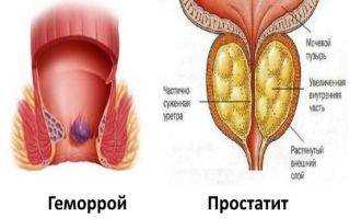 Суппозитории для лечения простатического и геморроидального воспаления