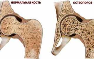 Какой кальций нужно принимать при остеопорозе: полезные советы