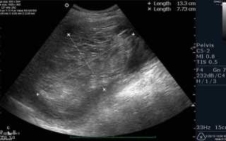 Какими должны быть размеры матки на УЗИ?