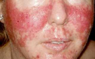 Особенности псориаза на лице и какими методами его можно вылечить