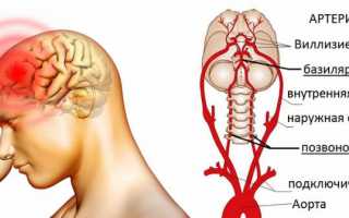 Что такое и как лечат синдром позвоночной артерии