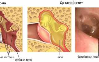 Что делать если болит козелок на ухе при нажатии?