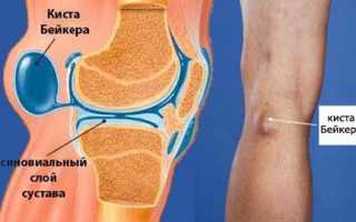 Киста сустава: причины, симптомы, методы диагностики и лечения