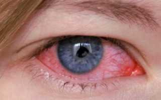 Методы лечения аллергического конъюнктивита глаз и его симптомы у детей и взрослых