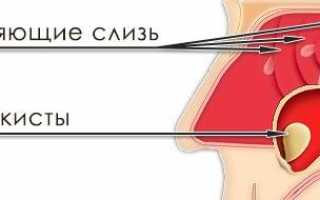 Киста левой и правой верхнечелюстной пазухи