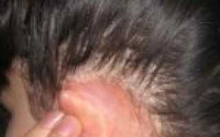 Зудящее чувство кожи головы при дерматите: что это и как избавиться от заболевания