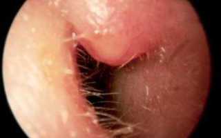 Как лечить острый средний отит уха?