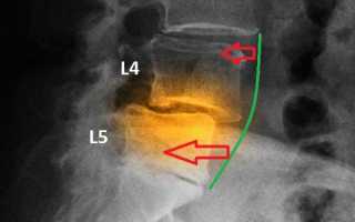 Ретролистез l5 позвонка: что это такое, его причины, симптомы и методы лечения