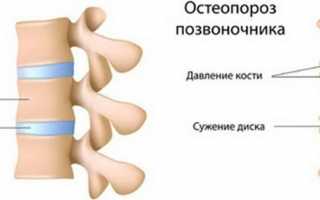 Остеопороз позвоночника: симптомы, степени, лечение традиционными и народными методами