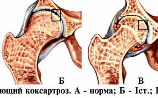 Коксартроз тазобедренного сустава – степени развития и способы лечения