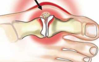 Воспаление сустава большого пальца ноги: лечение и диагностика