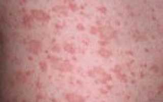Болезнь Жибера (розовый лишай): симптомы и лечение