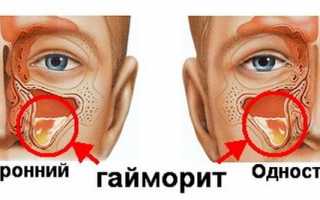 Какими медикаментами можно лечить гайморит?