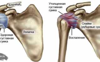 Периартрит плечевого сустава: особенности патологии