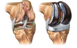 Что ожидает пациента после эндопротезирования коленного сустава?