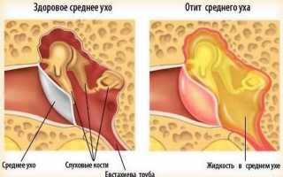 Что такое адгезивный отит?