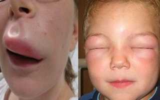 Большие неприятности от маленького хомячка — как не стать жертвой аллергии?