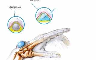 Гигрома сустава: насколько опухоль опасна для жизни?