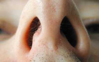 Чем лечить ожог слизистой носа?