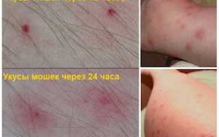 Как выглядит укус мошки: признаки, лечение обычной и аллергической реакции