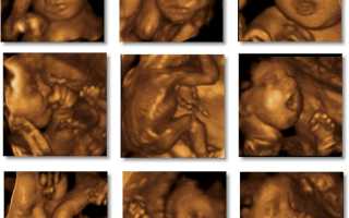 На каком сроке беременности делают 3D УЗИ?