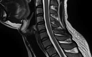 Что покажет МРТ отдела шейного позвоночника