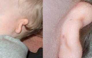 Чем и как лечить ухо ребенку в домашних условиях?