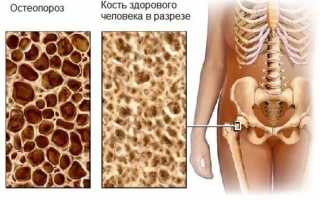 Как лечить остеопороз различными методами?