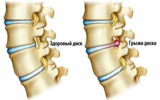 Грыжа позвоночника: что это такое?