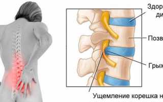 Эффективные препараты для лечения межпозвоночной грыжи поясничного отдела