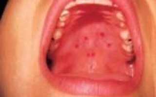 Першение в горле вызывает кашель: как лечить, чтобы проблему победить