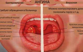 Что можно и нельзя кушать при ангине